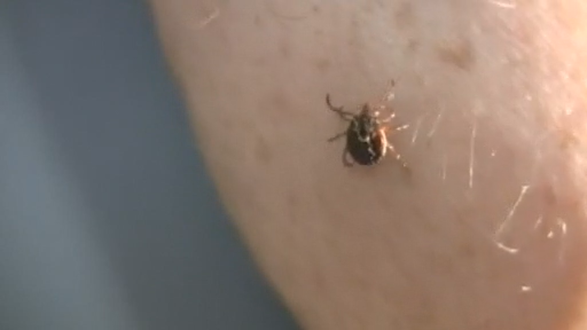 Lyme Disease